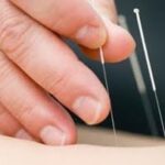 Illustration acuponcture au Cabinet Objectif Santé du Lude